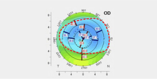 고도난시 교정으로 인해 각막 모양이 변형된 경우 이미지 